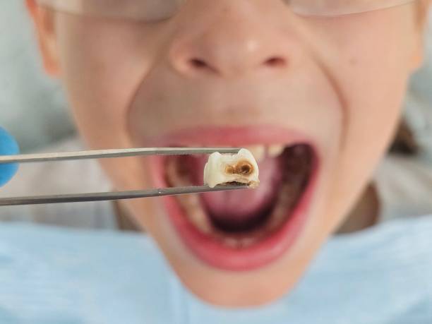 Best Emergency Dentist for Lost Fillings or Crowns in Pine Lakes, FL